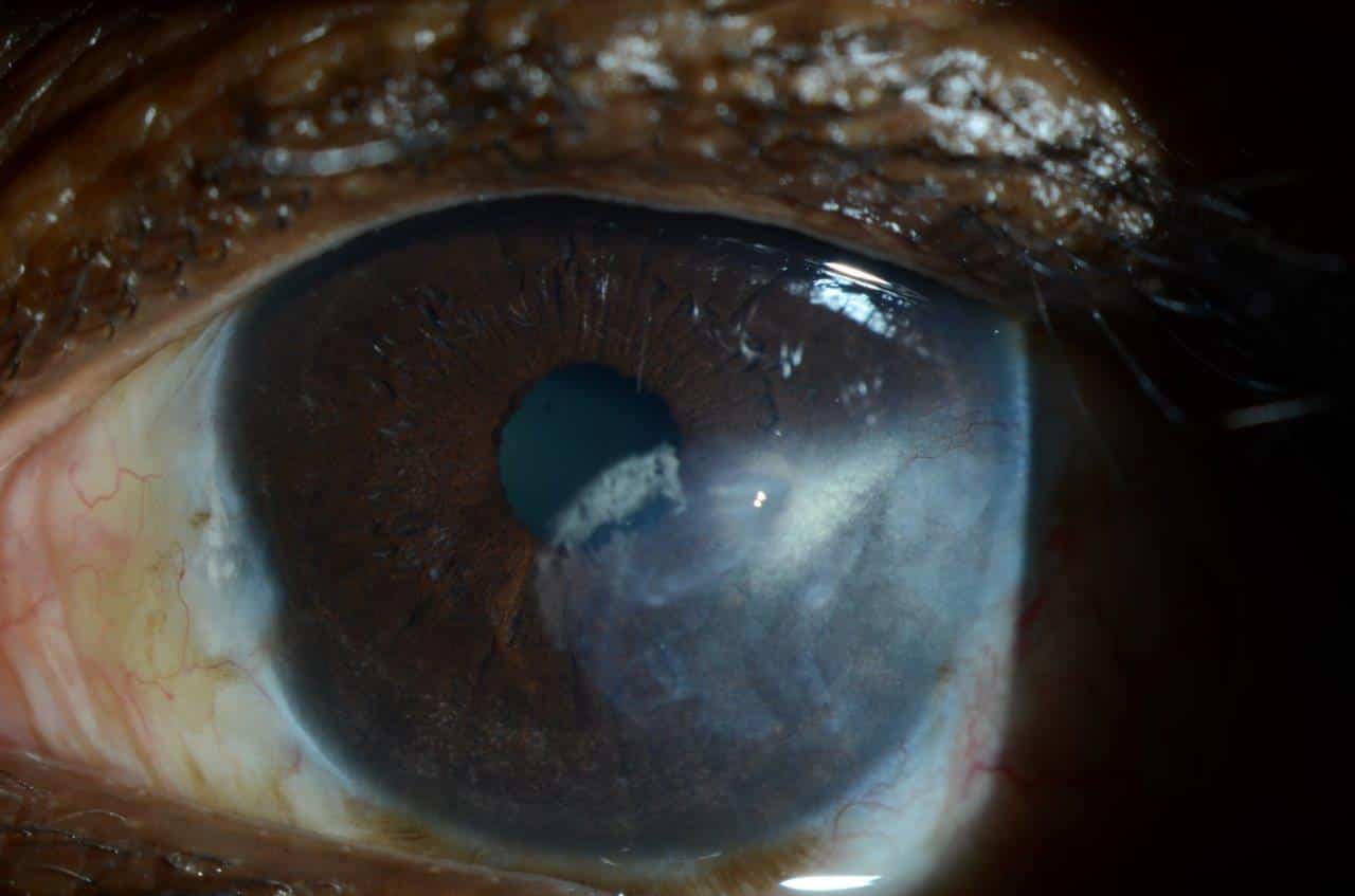 Pterygium Scar - Corneal Transplant